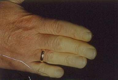 iloprost reduce the frequency and severity of SScrelated Raynaud s phenomenon attacks.
