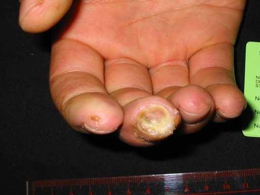 SSc- digital vasculopathy (Raynaud s phenomenon, digital ulcers) (II) 3. Bosentan has no proven efficacy in the treatment 3.