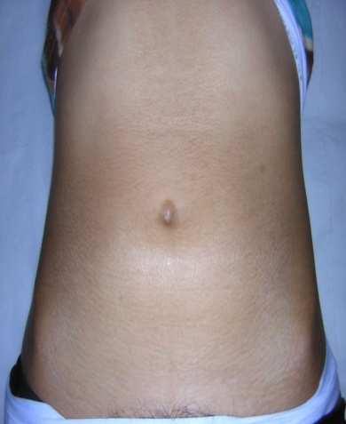SSc- skin involvement 1. Two RCTs have shown that methotrexate improves skin score in early diffuse SSc.