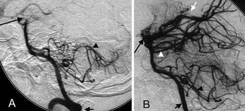 Cerebral Angiography Case Report The cerebral angiogram of a 67-year-old woman presenting with acute onset unresponsiveness and quadriparesis.