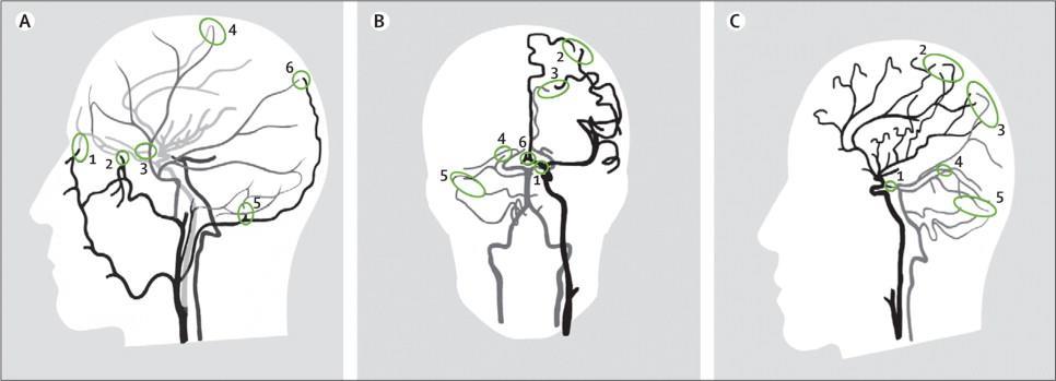 Figure 1 Cerebral arterial circulation (A) Extracranial arterial collateral circulation.