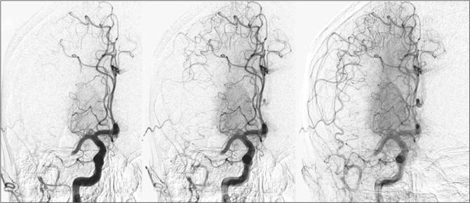 Figure 3 Collateral flow viewed with cerebral digital subtraction angiography Acute right middle cerebral artery occlusion in a 63- year-old man with sudden onset of left hemiparesis, showing (from