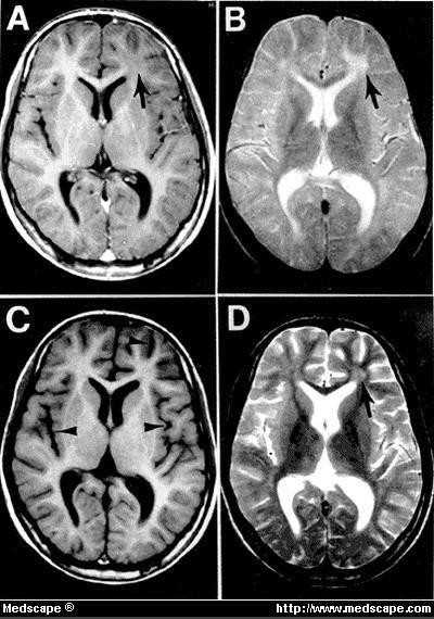 A diagnosztika fizikai háttere Legyen akkor CT A komputertomográfia (Computed [Axial] Tomography, CT vagy CAT) a