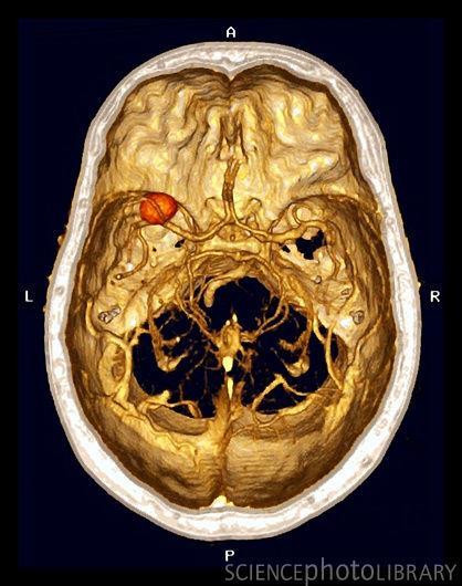 Cerebral aneurysm. Three-dimensional coloured computed tomography (CT) scan of an aneurysm (orange ball) in a blood vessel of the brain.
