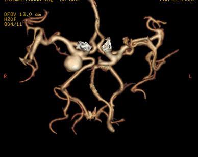 It is caused by a weakening of the vessel wall, which may be caused by hardening of the vessel (atherosclerosis), high blood pressure or injury.