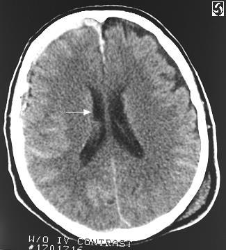 A CT felvételen látható diagnosztikus jellegű eltérések