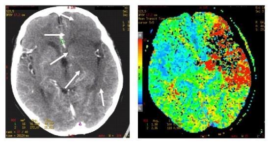 CT és az agyi erek Agyvérzés CT képe(a nyilak jelzik az stroke-határát