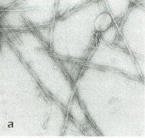 Az amiloid plakkok kialakulásának feltételezett mechanizmusa olvadt (molten globule) natív