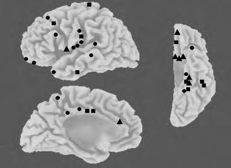 (Fisher-teszt, p=0,15). 4. ábra. GKTR-betegek (felsô és középsô képsor) és ACCID-betegek (alsó képsor) kóros LORETA-értékekkel.