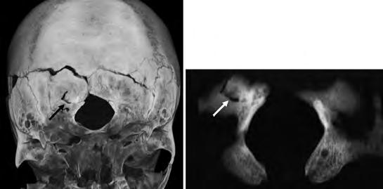 A foramen magnumra terjedô törésvonalak, a peremszéleken sclerosis, csontosodás jelei (3D VRT és MPR-CT-felvételek, Siemens Somatom Definition Flash 2 128 DSCT) térfogati ábrázolás (3 dimension