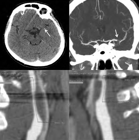 tiple in 10-15% of the cases 4.