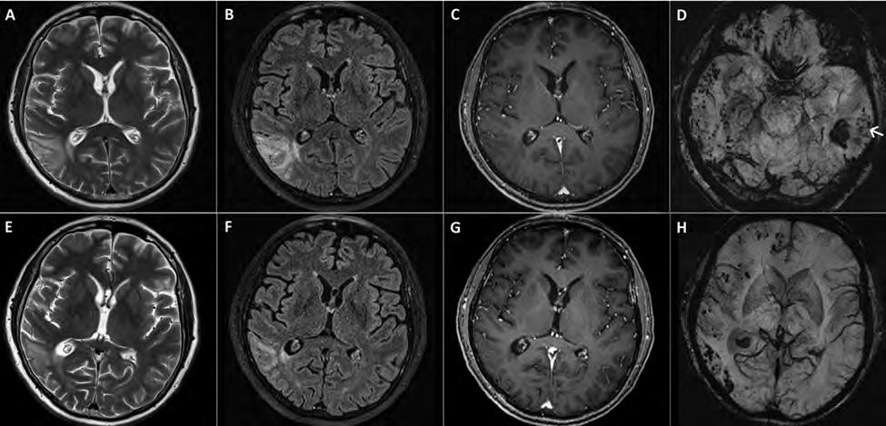 Figure 1. Follow-up MRIs after 1.5 and four months. Follow-up MRIs performed 1.