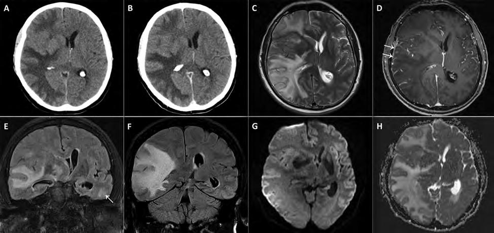 of the initial MRI examination show a space-occupying lesion predominantly involving the deep and subcortical white matter of the right cerebral hemisphere, but also the cortex and the left anterior