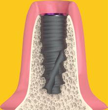 egyrészes A -típusú Conefit implantátumok Egyfázisú,