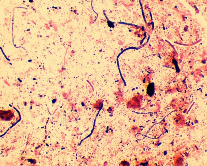 TGM: VEGYES (aerob+anaerob) DYSBACTERIOSIS Híg, bűzös hasmenés. Normál bélflóra gyér.