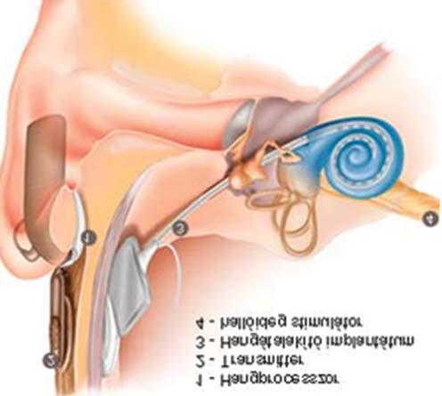 A cochlearis implantáció (CI) elve alapvetõen különbözik a fenti, ún. középfül-implantátumoktól.