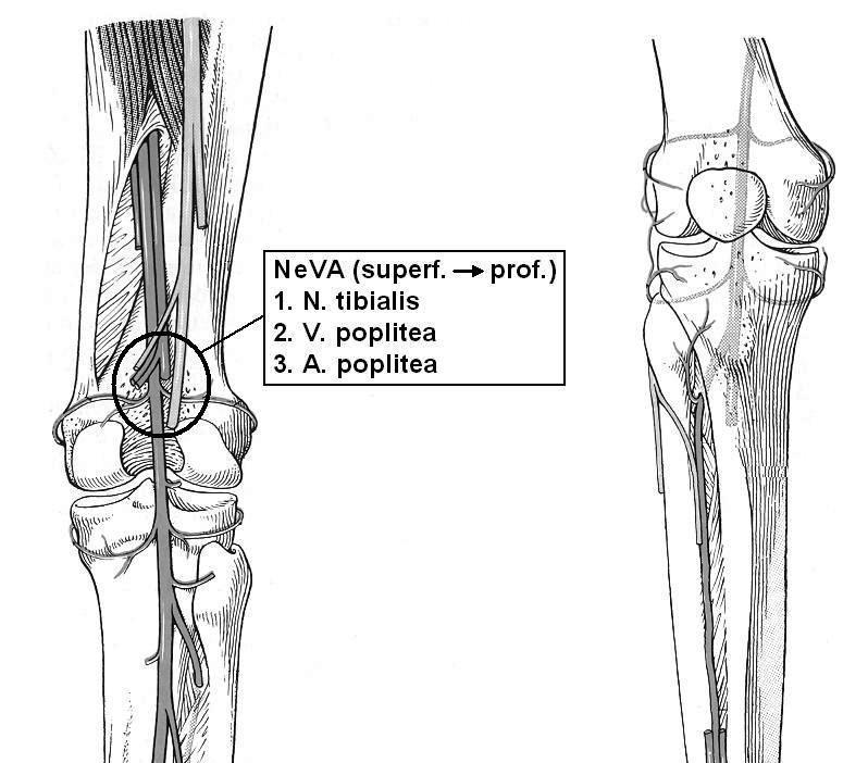 47 2) A. poplitea (fossa poplitea felületestől a mély felé olvasva: NEVA) Aa. surales kis ágak a lábikra izmaihoz A. genus superior med. et lat. A. genus media (térdízületbe!