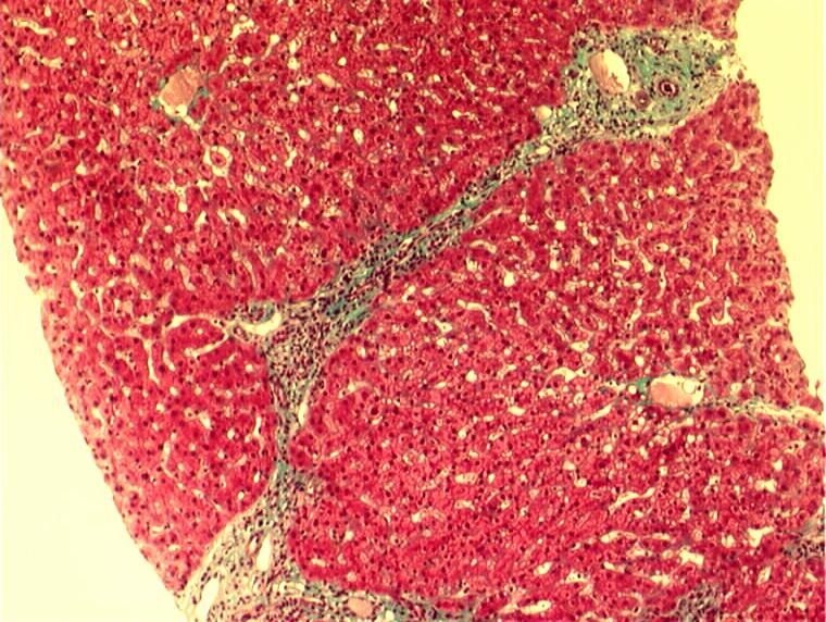 METAVIR Stages of