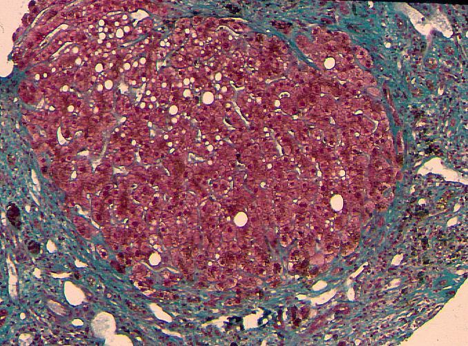 Periportale fibrosis