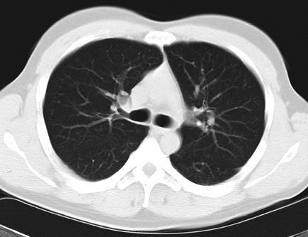 Cavitas thoracis Computertomográfiás keresztmetszeti kép a bifurcatio tracheae magasságában, alulnézet Sternum Pleura mediastinalis V.