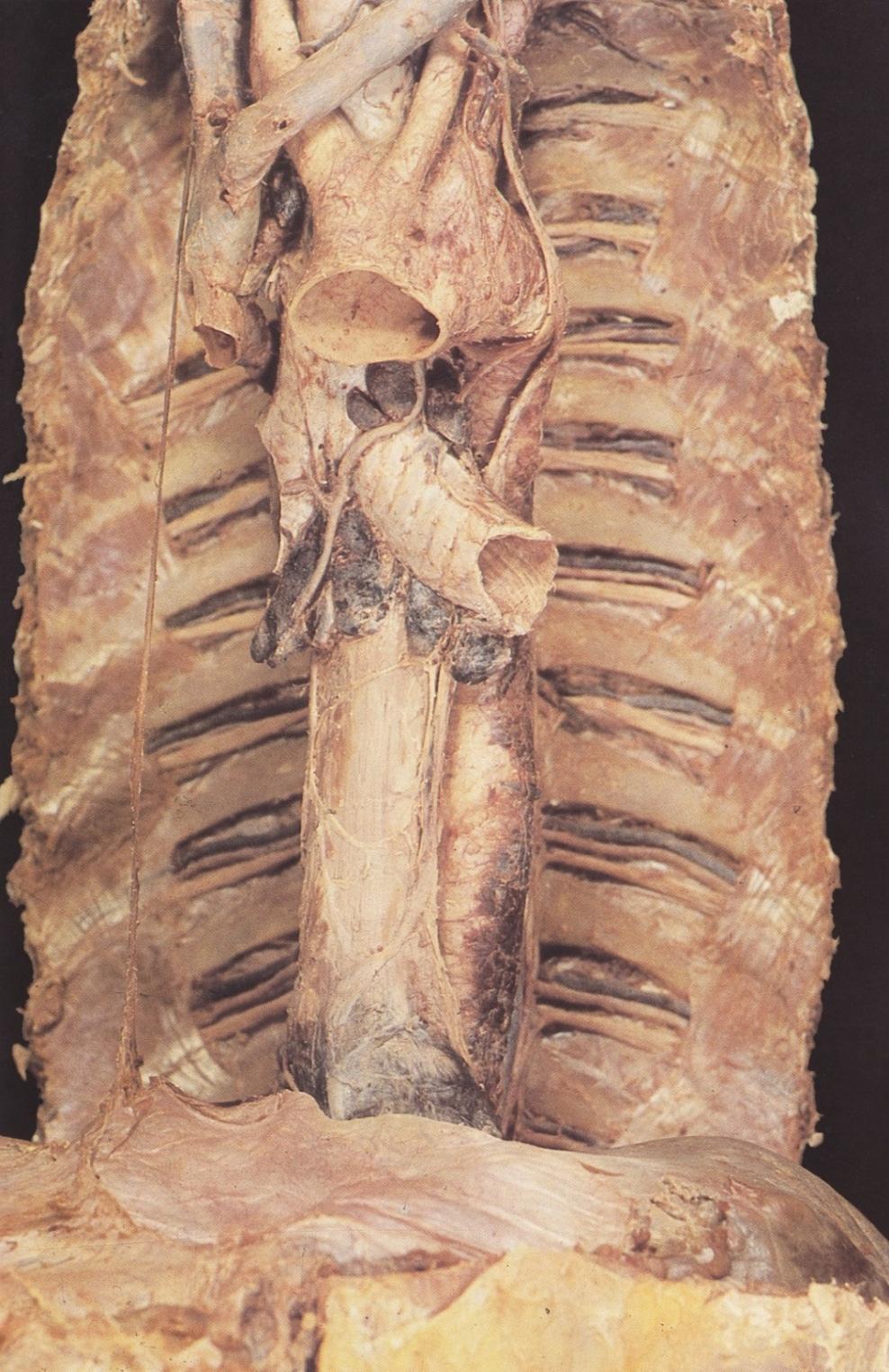 2. 3. 5. 6. 7. 1. 4. 8. A mediastinum superius, a mediastinum posterius és a spatium intercostale boncolandó képletei * 10. 11. Oesophagus 9. 8. Aorta thoracica ** Spatium intercostale 1.