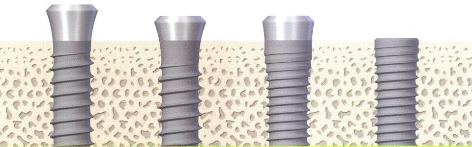 ITI-Straumann implantátumok formájának alakulása Straumann Standard 1996