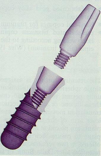 Az ITI-Straumann implantációs rendszer története: Implantátum- fejek 1986 Bonefit