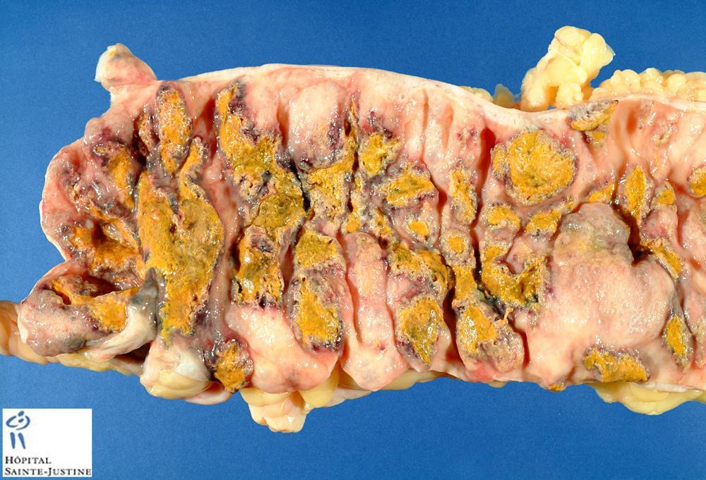 PSEUDOMEMBRANOSUS COLITIS