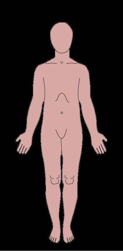 multiplex, Schizophrenia Haematopoietikus