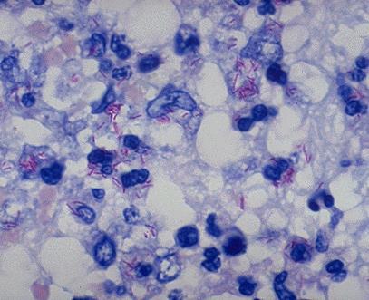 8. Ziehl-Neelsen festés menete saválló festés (Mycobacteriumok speciális festése) Karbol-fuchsin (szűrőpapíron!