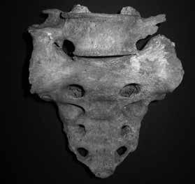2: Reduced rib facet on T12. 3: Rudimentary twelfth rib, left 6.1 6.