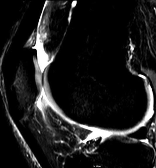 16 OSTEOLOGIAI KÖZLEMÉNYEK 2017/1-2 mányán belüli és a közvetlen környezetében lévő ciszták okozhatnak.