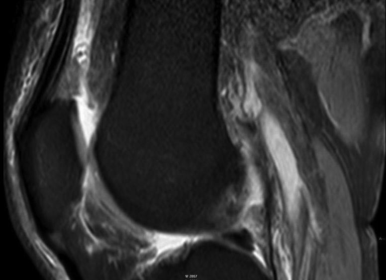 köszvényes tophus, glomus tumor, valamint keresztszalag sérülést követően küklopsz léziót okozó hegszövet.