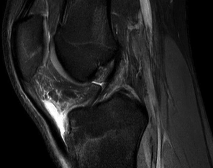 A patella porcban kóros fokozott jeladással chondromalatia látható.