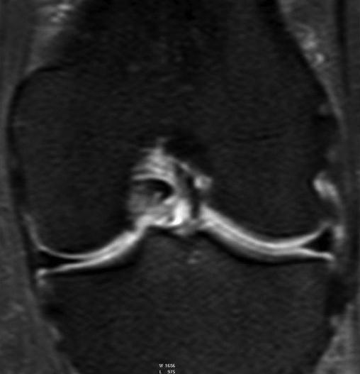valamint apex patellae szindróma: csontvelő ödéma a patella csúcsban és
