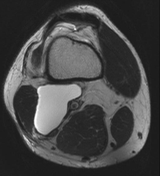 szekvencia: Pes anserinus bursitis. 14. kép.