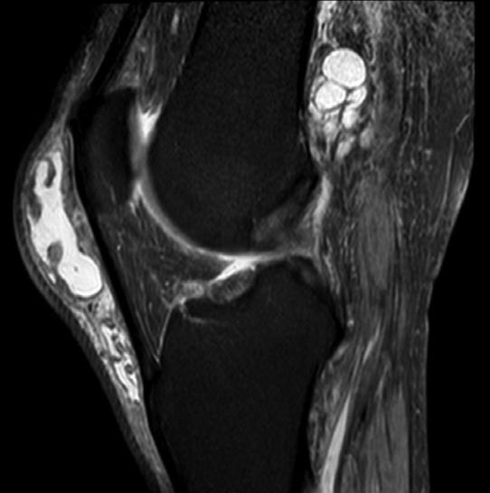 n (spondylitis ankylopoetica). 28. kép.