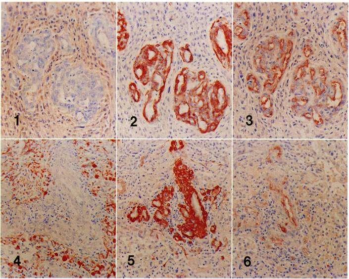 A glomeruloid burjánzás alapja a simaizom