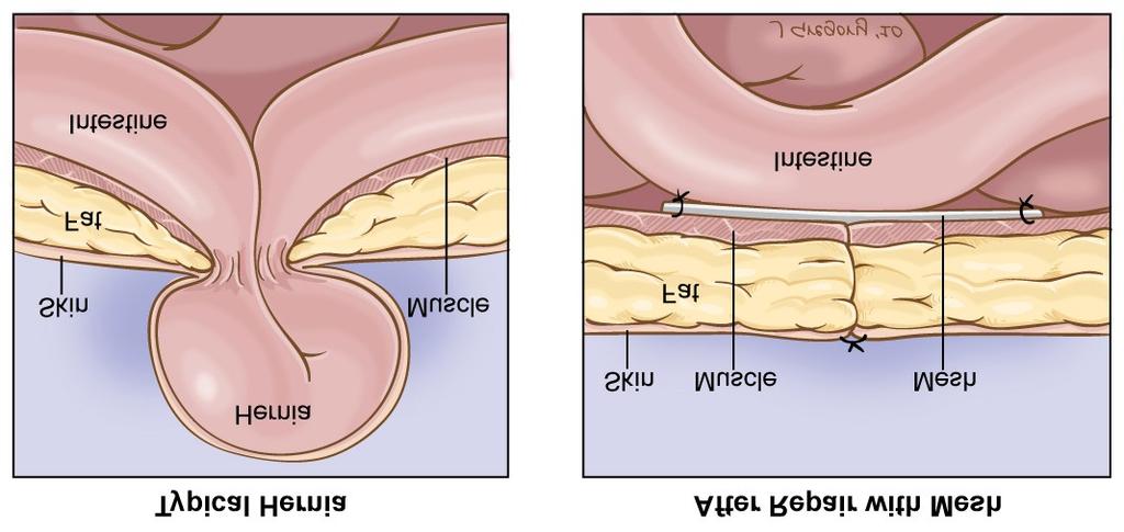 Sérvm tét A sérv sebészi betegség, csak m tét útján gyógyítható meg véglegesen Több sebészeti eljárás (m tét) ismert Nyílt feszüléses eljárások a sérvkaput képz