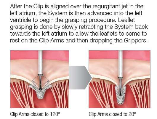 for required radial strength The MitraClip system Percutaneous repair of the