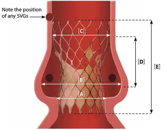 Súlyos hypertrophia, subvalvularis obstructio Aorta gyök, ascendens anatomiai