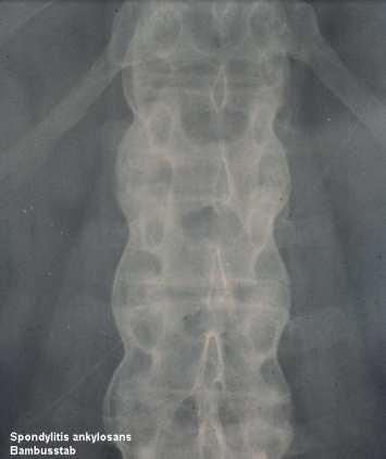 Spondylitis ankylopoetica A Bechterew kór (más néven spondylitis ankylopoetica, rheumatoid spondylitis) esetén a betegek több mint 90%-a HLA-B27 pozitív.