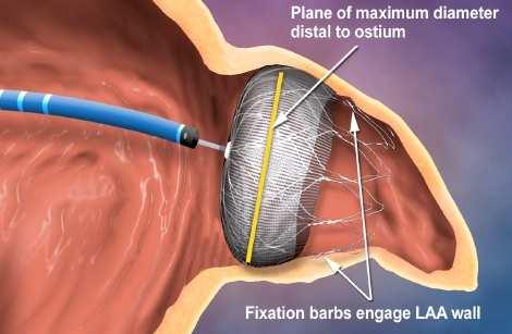 WATCHMAN LAA Closure