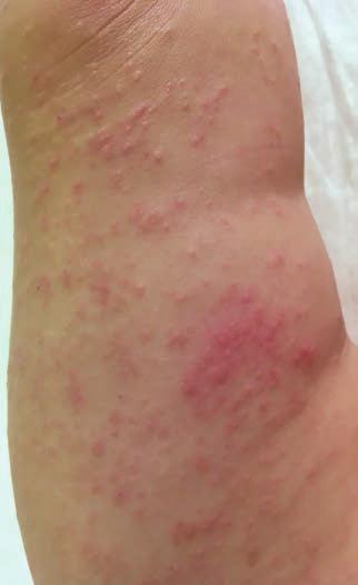 alakulnak ki a tünetek. Az atópiás monoklit a rhinitis allergica egyik manifesztációjának is tartják (14). A sötét elszíneződés erőssége korrelál az rhinitis allergica fennállásának időtartamával.