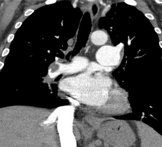 pleural