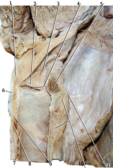 membrana thyrohyoidea(1), plica vestibularis(2), vestibulum(3), ventriculus(4), m.
