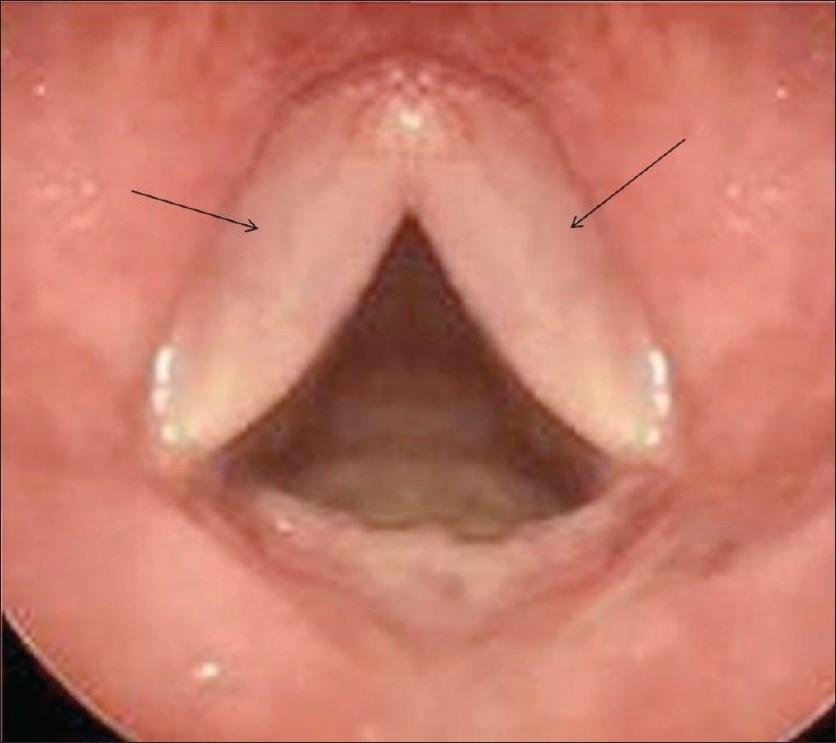 Laryngoscopia Hangrés nyitott