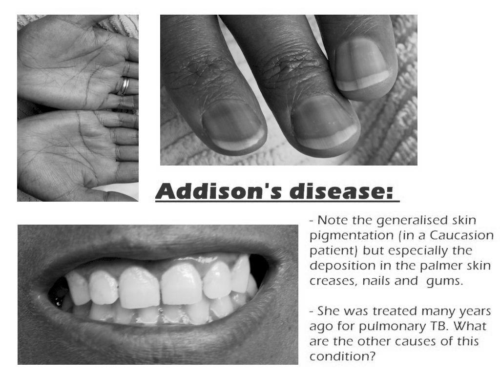 Addison-krízis: életet veszélyeztető állapot Adenohypophysis hormonjai 1.