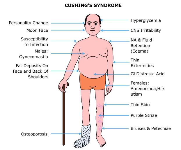 fokozott kortizol termelődés: Cushing kór (hiperkortizolizm) gyakran kortikoszteroid kezelés mellékhatása tünetei: súlynövekedés, a bőr vékony