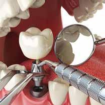 Implantul dentar este cea mai recomandată şi sănătoasă metodă de tratament în cazul lipsei dinţilor naturali.
